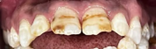 Whitening & ICON before