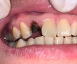 Dental crown before
