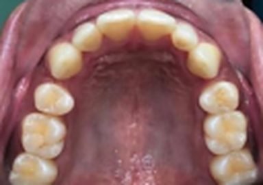 Clear aligners before