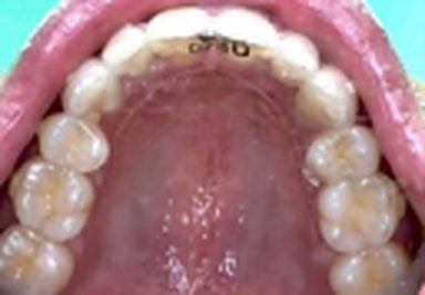 Clear aligners after