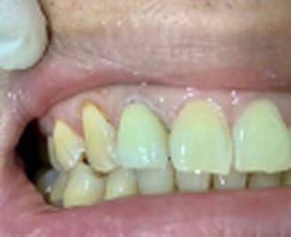Dental crown after