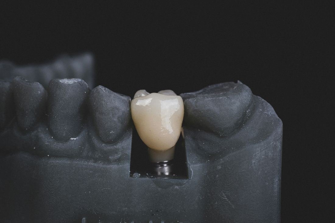Porcelain crown on a dental implant model